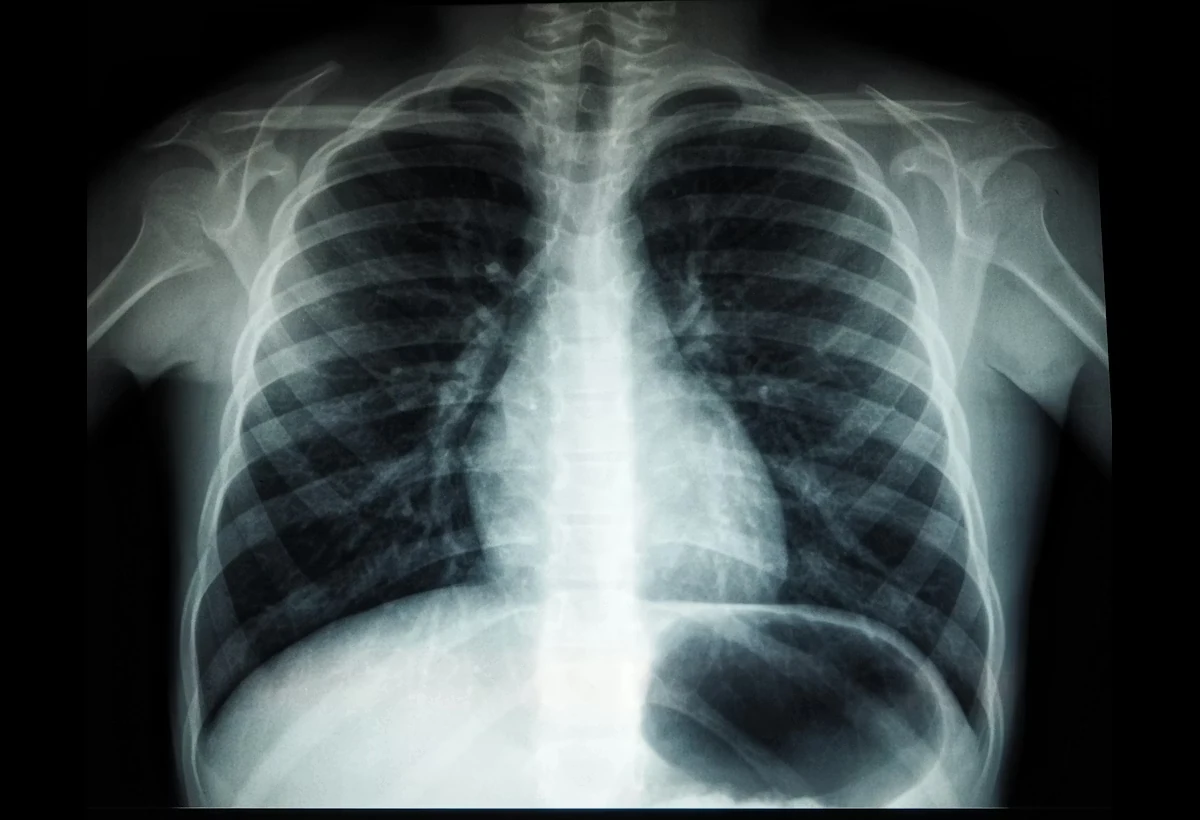 Pacient prežil neuveriteľných 48 hodín bez pľúc pred transplantáciou